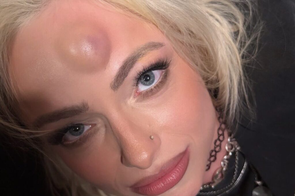 Liv Morgan Discusses Hematoma From Stephanie Vaquer – Fightful Liv Morgan Discusses Hematoma From Stephanie Vaquer - Fightful